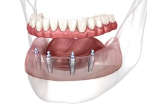 foreign dental implants epping